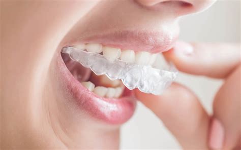 Orthodontic Treatments: Braces & Invisalign 